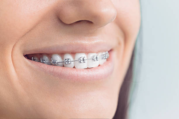 Best Traditional Braces  in Beckett Ridge, OH